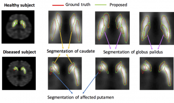 New pre-print on segmentation of DaT SPECT images